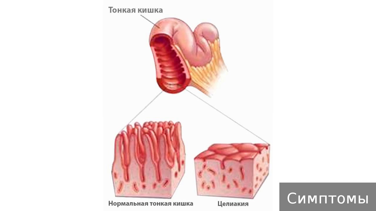Причины и симптом заболевания